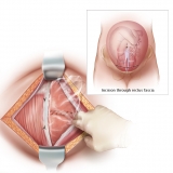 USE OF ADHESION BARRIER IN C-SECTION