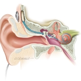 COCHLEAR IMPLANT