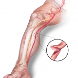 CRYOVEIN - SAPHENOUS VEIN ALLOGRAFT