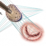 MITRAL VALVE REPAIR