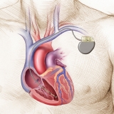 PACEMAKER