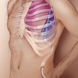 PLEURAL DRAINAGE