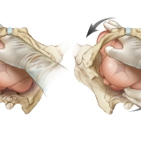 DELIVERY MANEUVER for SHOULDER DYSTOCIA