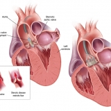 LOTUS® AORTIC VALVE