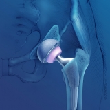 BIRMINGHAM HIP IMPLANT