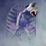 VENTRICULAR ASSIST DEVICE