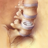 PROSTHETIC DISC NUCLEUS