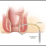 FISTULA REPAIR