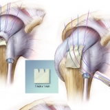 ROTATOR CUFF REPAIR