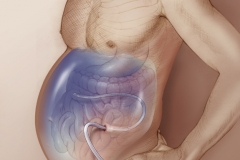 ASCITES DRAINAGE