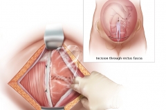 USE OF ADHESION BARRIER IN C-SECTION