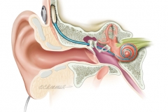 COCHLEAR IMPLANT