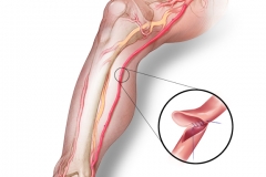 CRYOVEIN - SAPHENOUS VEIN ALLOGRAFT