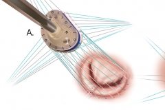 MITRAL VALVE REPAIR