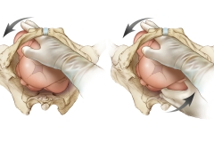 DELIVERY MANEUVER for SHOULDER DYSTOCIA