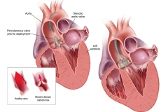 LOTUS® AORTIC VALVE