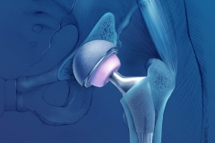 BIRMINGHAM HIP IMPLANT