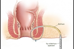 FISTULA REPAIR