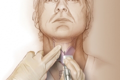 VOCAL FOLD AUGMENTATION