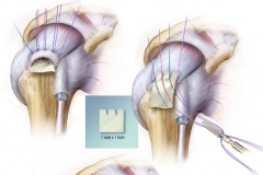 ROTATOR CUFF REPAIR