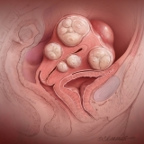 UTERINE FIBROID TUMORS