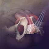 PROSTATIC SLING