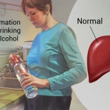 ALCOHOLIC HEPATITIS