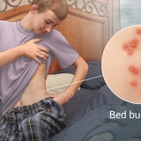 BED BUG BITES