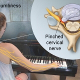 CERVICAL RADICULOPATHY