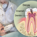 DENTAL CARIES