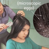 HEAD LICE