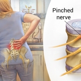 LUMBAR RADICULOPATHY