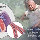 PULMONARY HYPERTENSION