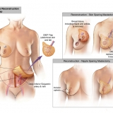 IMMEDIATE BREAST RECONSTRUCTION