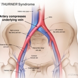 MAY THURNER SYNDROME