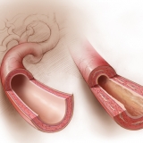 ARTERIAL CALCIFICATION