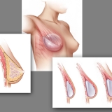 BREAST RECONSTRUCTION WITH PECTORAL EXTENDERS
