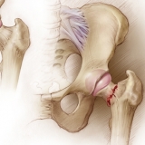 HIP FRACTURE