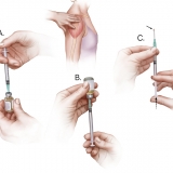 INJECTION GUIDE